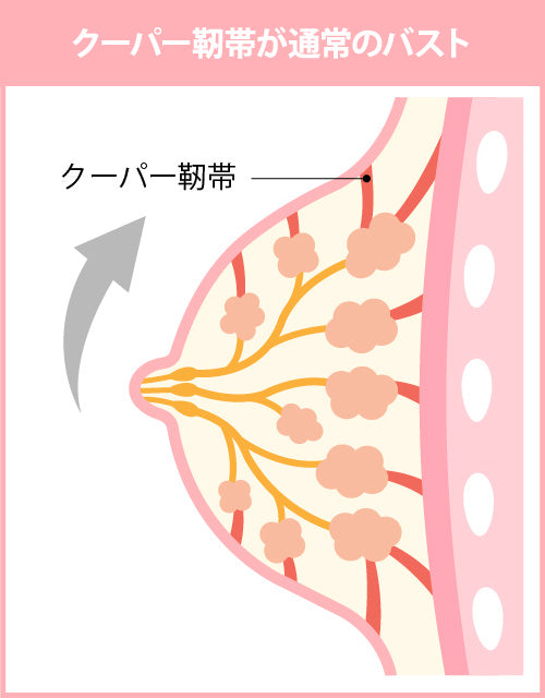 クーパー靭帯が通常のバスト