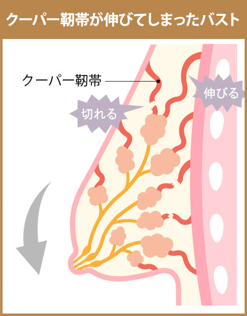 クーパー靭帯が伸びてしまったバスト